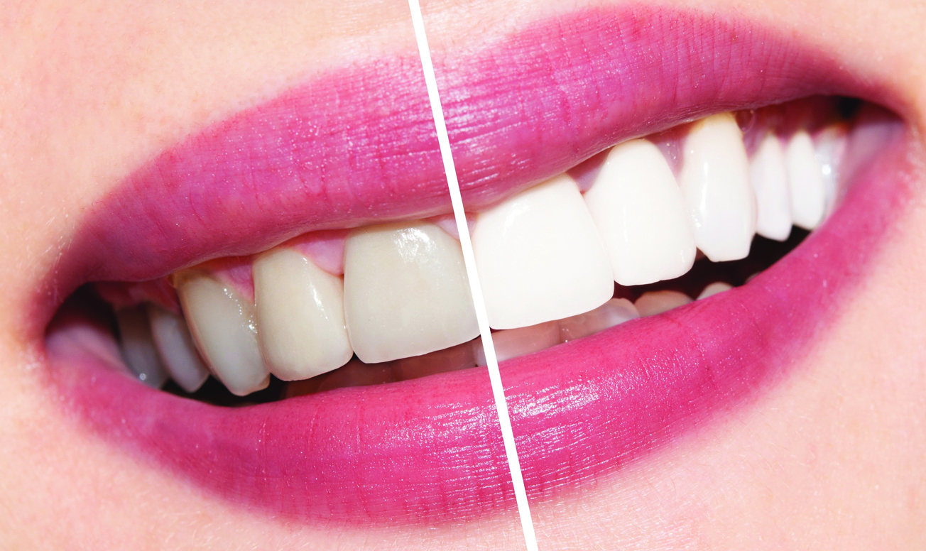 Реставрационное отбеливание (ламинирование) зубов